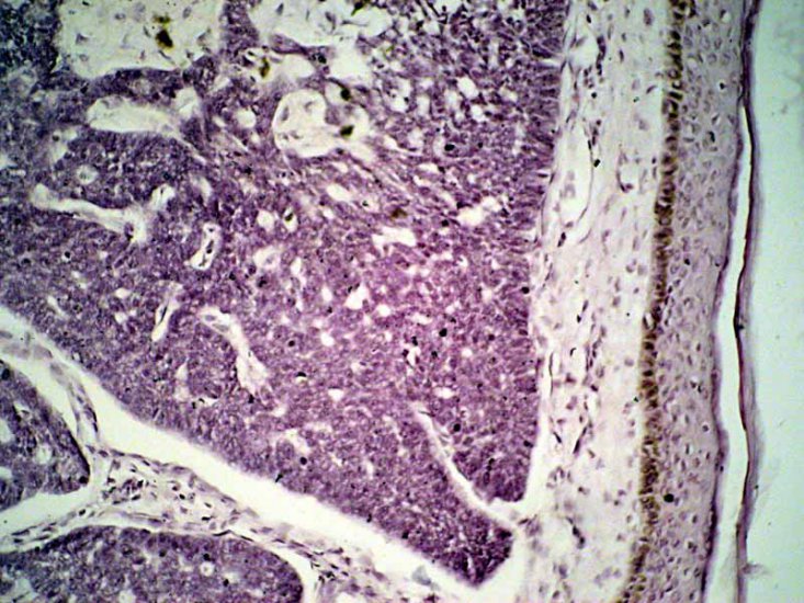 Zdjęcia ze strony katedry patomorfologii - CarcinomaBasocellulare_x20.jpg